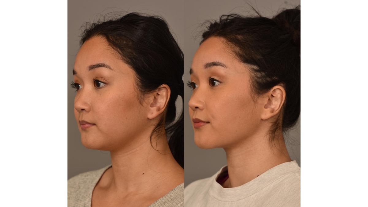 Buccal-Fat-Removal-Before-and-After